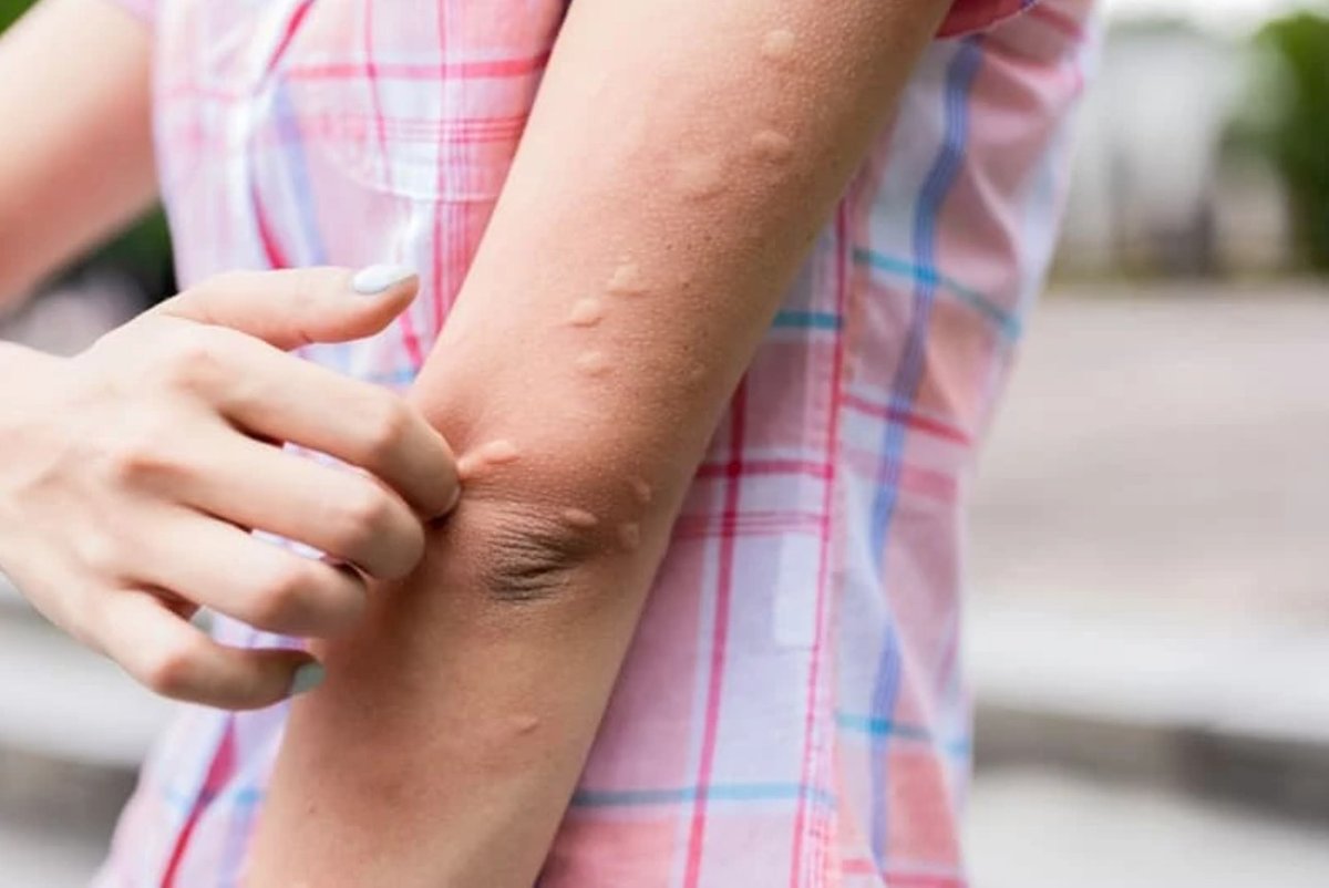 Vết muỗi đốt gây ngứa và khó chịu